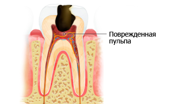 Сильний зубний біль, що робити (періодонтит) стоматологія