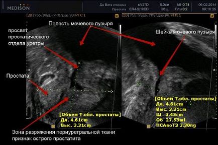 Simptomele de prostatită la bărbații din fotografie