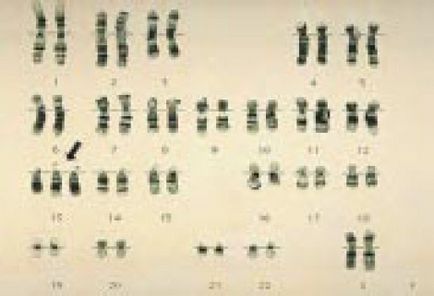 Sindromul Patau (trisomia pe cromozomul 13) și sindromul Edwards (trisomia pe cromozomul 18)