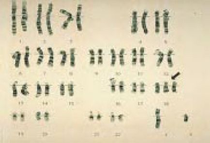 Patau-szindrómát (triszómia kromoszóma 13) és Edwards-szindrómát (triszómia kromoszóma 18)