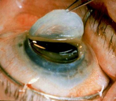 Keratoplasticát műtét, áttekintésre, klinikák, az árak (műtét utáni) Keratoplasticát műtét, áttekintésre, klinikák, árak