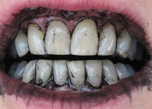 Засіб і методи для відбілювання зубів гель white light, 3d white whitestrips, гелі та інші методи