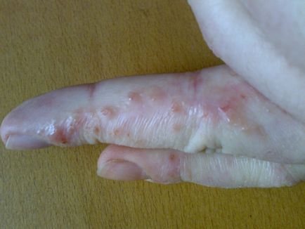 Staphylococcus fertőzés, típusai, tünetei, diagnózis és kezelés (tünetek) Staphylococcus fertőzés, típusai, tünetei, diagnózis és kezelés