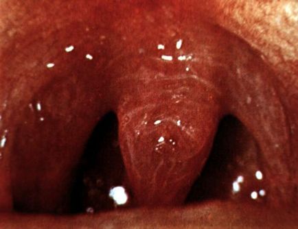 Stafilococice infecții tipuri, simptome, diagnostic și tratament