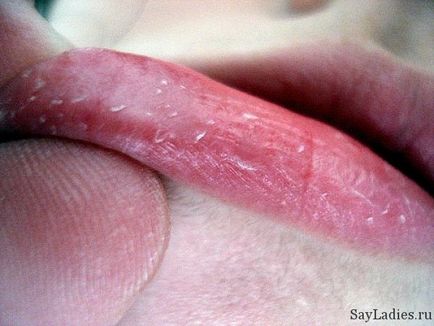 Сухість губ і розтріскування лікування, засоби