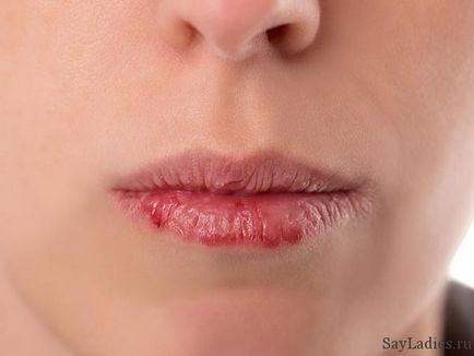 Сухість губ і розтріскування лікування, засоби