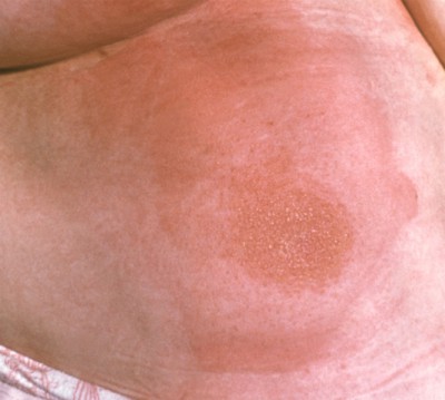 Тамбовський шкірно-венерологічний диспансер - лісовий (луговий) дерматит