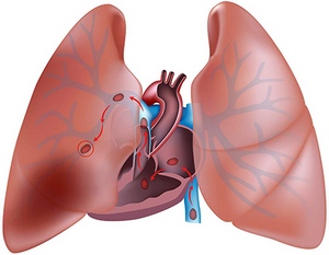 Tal (tromboembolismul arterei pulmonare) - tratamentul bolii