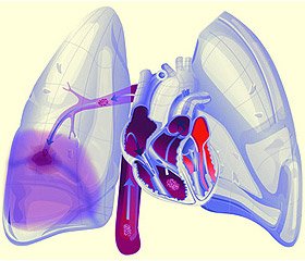 Tüdőembólia diagnózis és kezelés algoritmusok online kiadásában - orvosi hírek