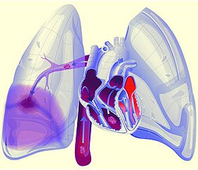 Тромбоемболія легеневої артерії алгоритми діагностики та лікування, інтернет-видання - новини медицини