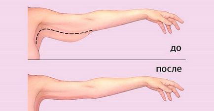 Távolítsuk el a felesleges zsírt a karok 3 módon, hogy a munka