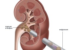 Eliminarea pietrelor din selecția rinichilor a metodei de operare, cauzele apariției, prevenirea