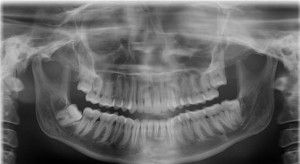 Видалення зуба як довго заживає ясна і лунка, якщо складна рана