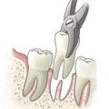 Видалення зуба як довго заживає ясна і лунка, якщо складна рана
