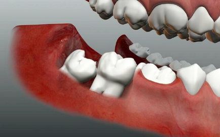 Eliminarea dintelui înțelepciunii cum să ușureze consecințele