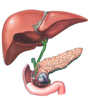 Видалили жовчний міхур які можуть бути наслідки, лікування шлунково-кишкового тракту