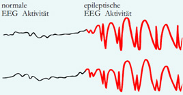 Clinica universitară Bonn - diagnostic și tratament al epilepsiei în Germania