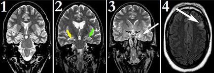 Clinica universitară Bonn - diagnostic și tratament al epilepsiei în Germania