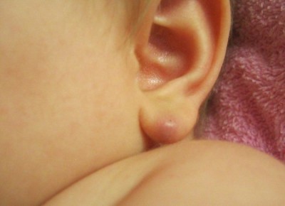 Urechea copilului a fost umflată și roșie, de ce, de ce și ce să facă