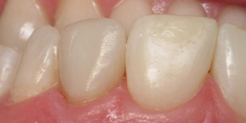 Instalarea unui sigiliu pe dintele prețurilor la Moscova, recenzii, adrese ale stomatologiei