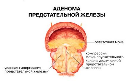 Узі простати яка техніка проведення і що дозволяє виявити