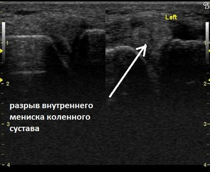 Uzi îmbină uzi cu umărul, genunchiul, articulațiile, încheietura mâinii, articulațiile mâinilor și articulațiilor