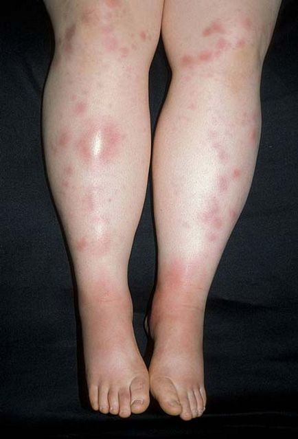 Erythema nodosum fotó talpra kezelés okoz tüneteket a gyermekeknél