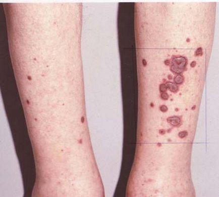 Erythema nodosum fotó talpra kezelés okoz tüneteket a gyermekeknél