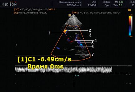 Discirculație venoasă în copilărie și adolescentă - soclu capsule