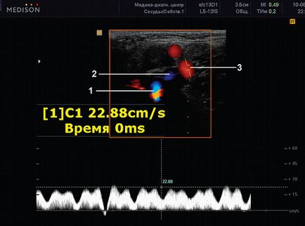 Discirculație venoasă în copilărie și adolescentă - soclu capsule