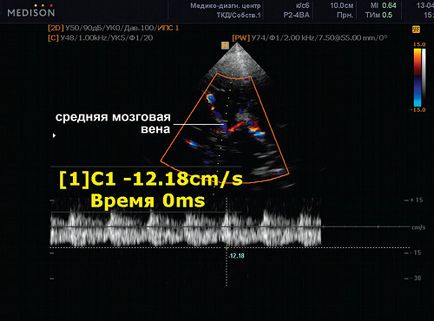 Discirculație venoasă în copilărie și adolescentă - soclu capsule