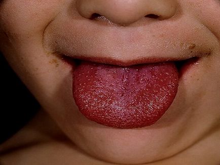 Torok fehér foltok - tünete a különböző betegségek, gorlor