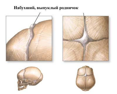 Convex fontanel sau umflarea fontanelului