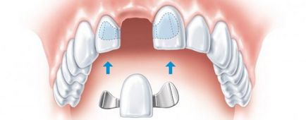 Тимчасові зубні протези що це, різновиди