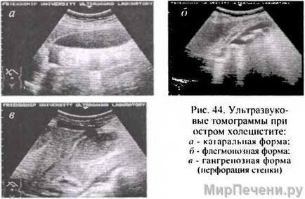 Cholecystitis felnőtteknél