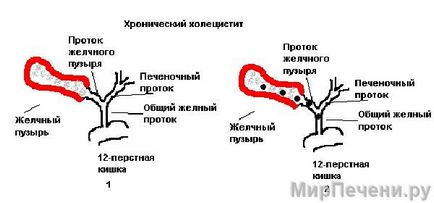 Холецистит у дорослих