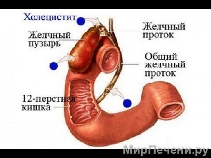 Cholecystitis felnőtteknél