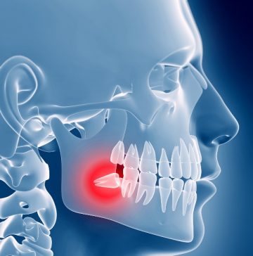 Зуб мудрості болить що робити в домашніх умовах, що пропонують клініки