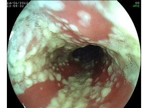 Viszketés cystitis nőknél okai és kezelése