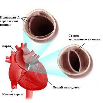 Suport aortic (bicuspid, bivalve, tricuspid)