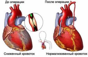 Operație by-pass aortocoronară