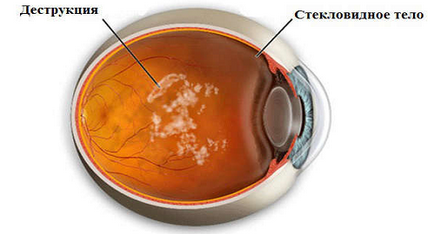 Care este distrugerea corpului vitros al ochiului
