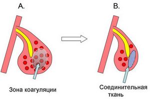 Дихателни упражнения с назална конгестия