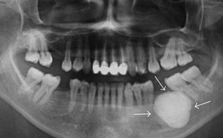 Tumorile osoase benigne - osteom