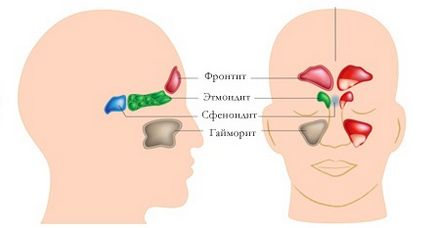 Simptomele de etmoidită, tratamentul la adulți și copii, varietăți (cronice, acute și polipozice)