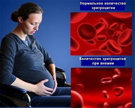 Cefaleea la începutul sarcinii - cauze și tratament