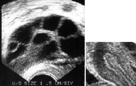 A indukciója szuperovuláció az in vitro megtermékenyítés (IVF)