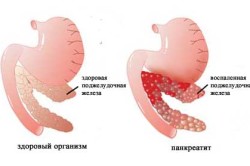 Як зупинити пронос при панкреатиті