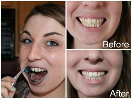 Cum sa albiti dintii cu carbune activ - curatarea la domiciliu, fotografie