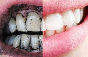 Як відбілити зуби активованим вугіллям - чистка в домашніх умовах, фото